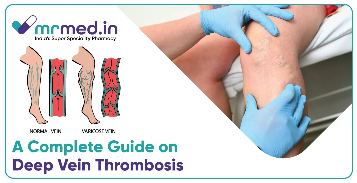 How To Treat Deep Vein Thrombosis DVT Prevent Blood Clots MrMed How To Treat Deep Vein Thrombosis DVT Prevent Blood Clots MrMed